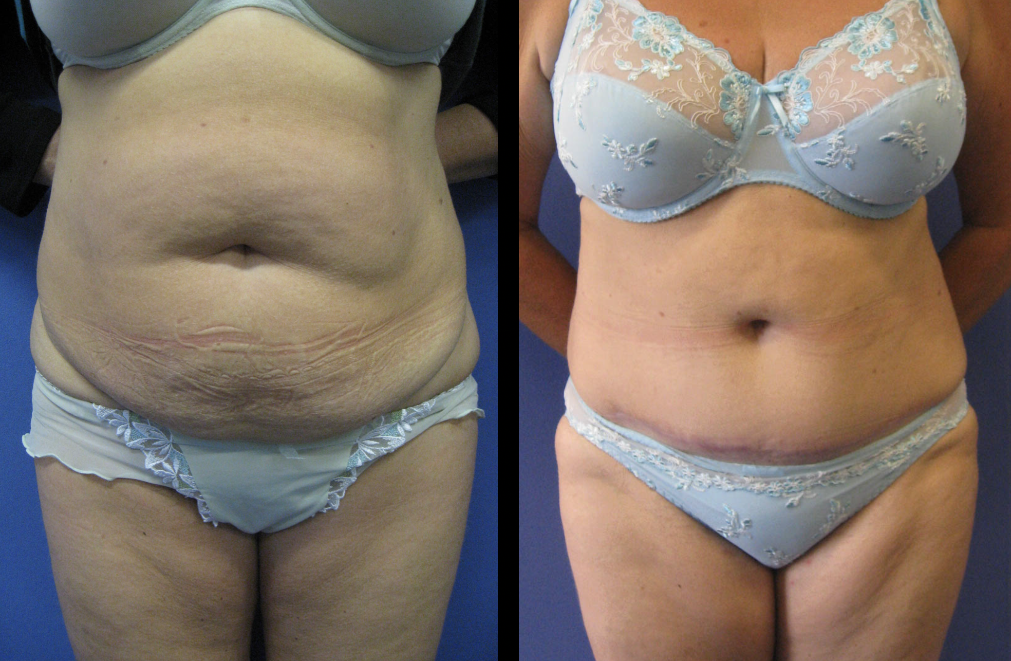 tummy tuck before and after, liposuction